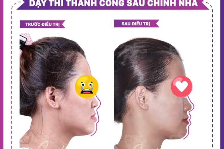 Niềng răng móm